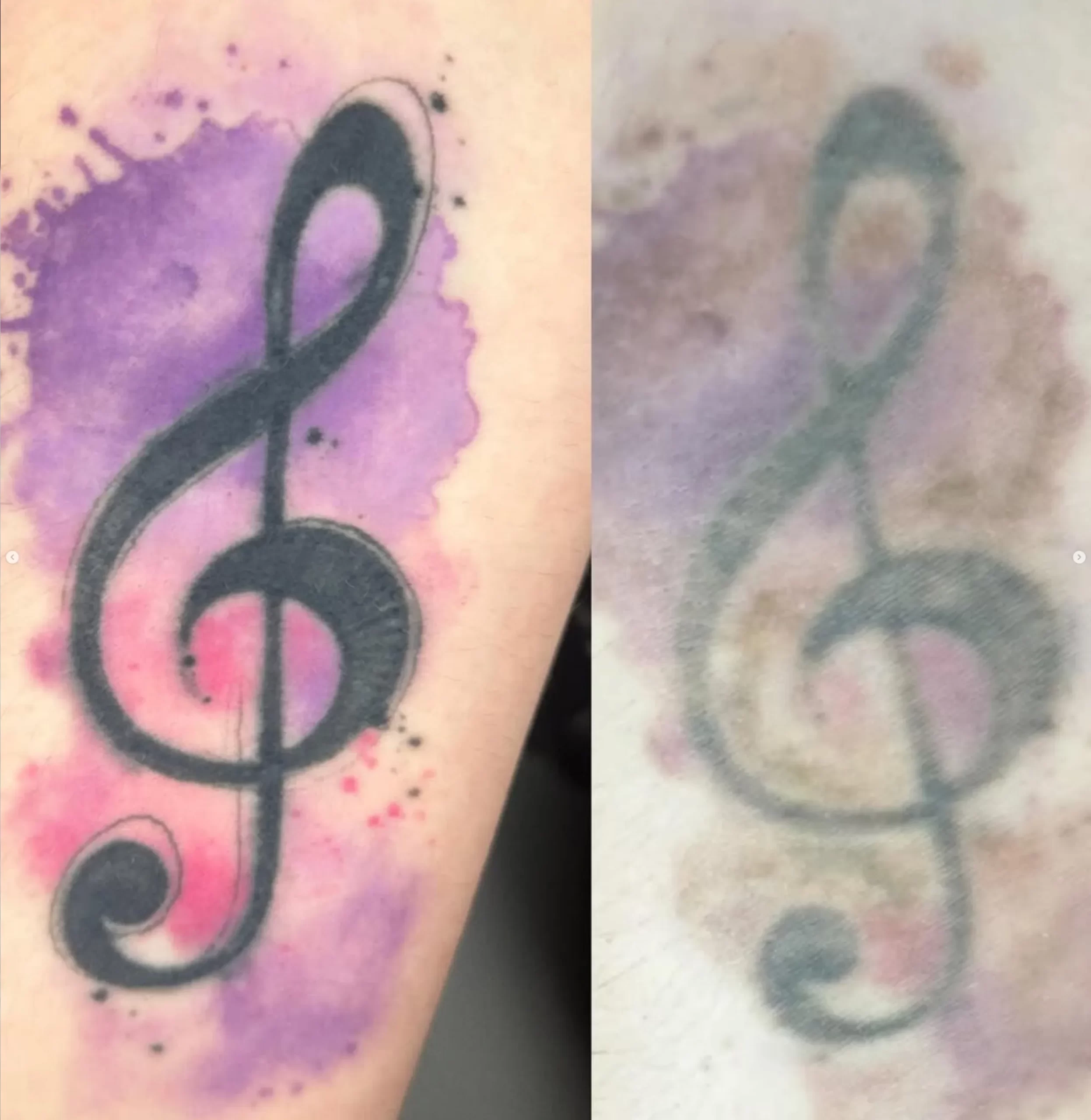 best laser tattoo removal melbourne