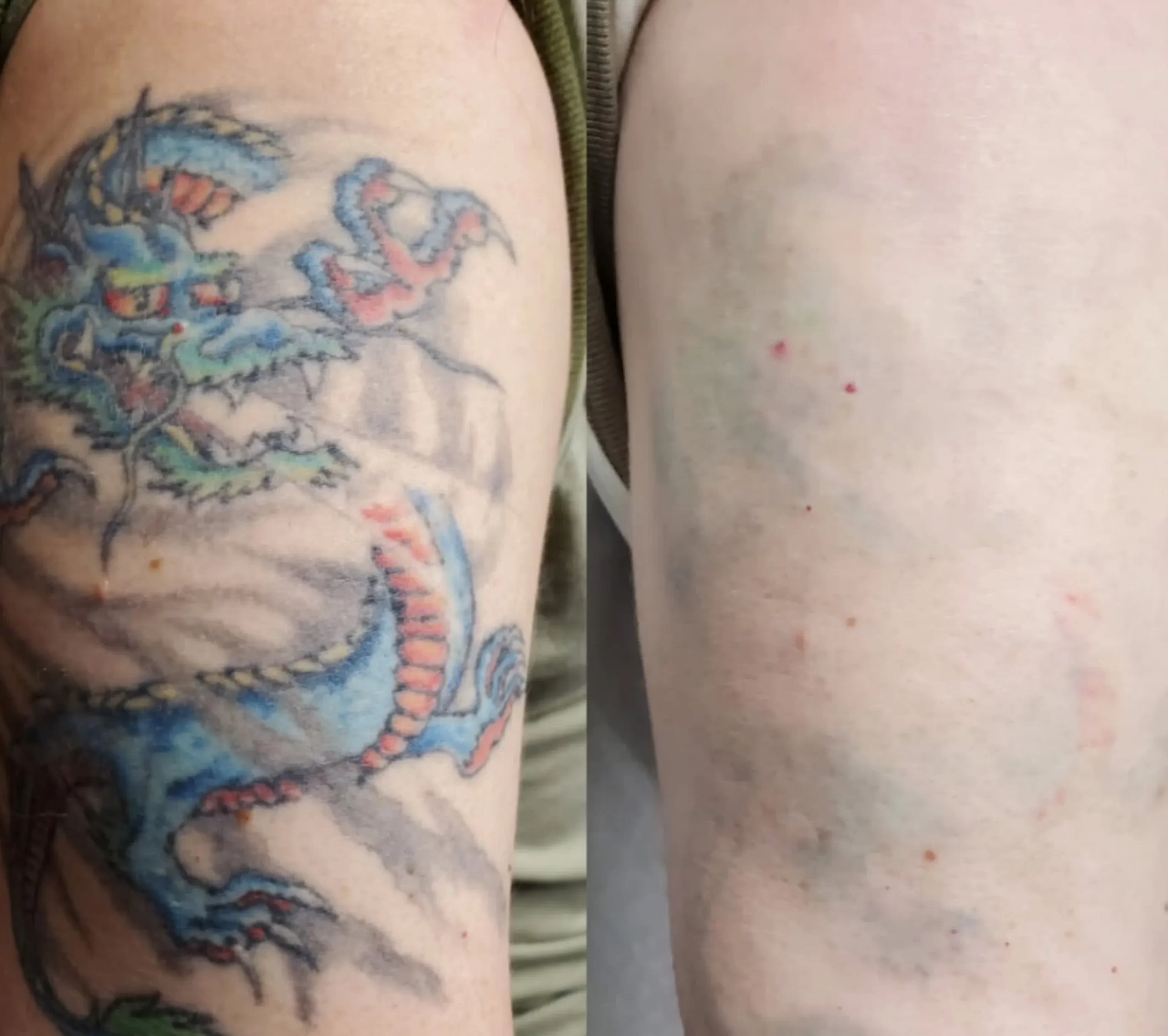 best tattoo removal melbourne