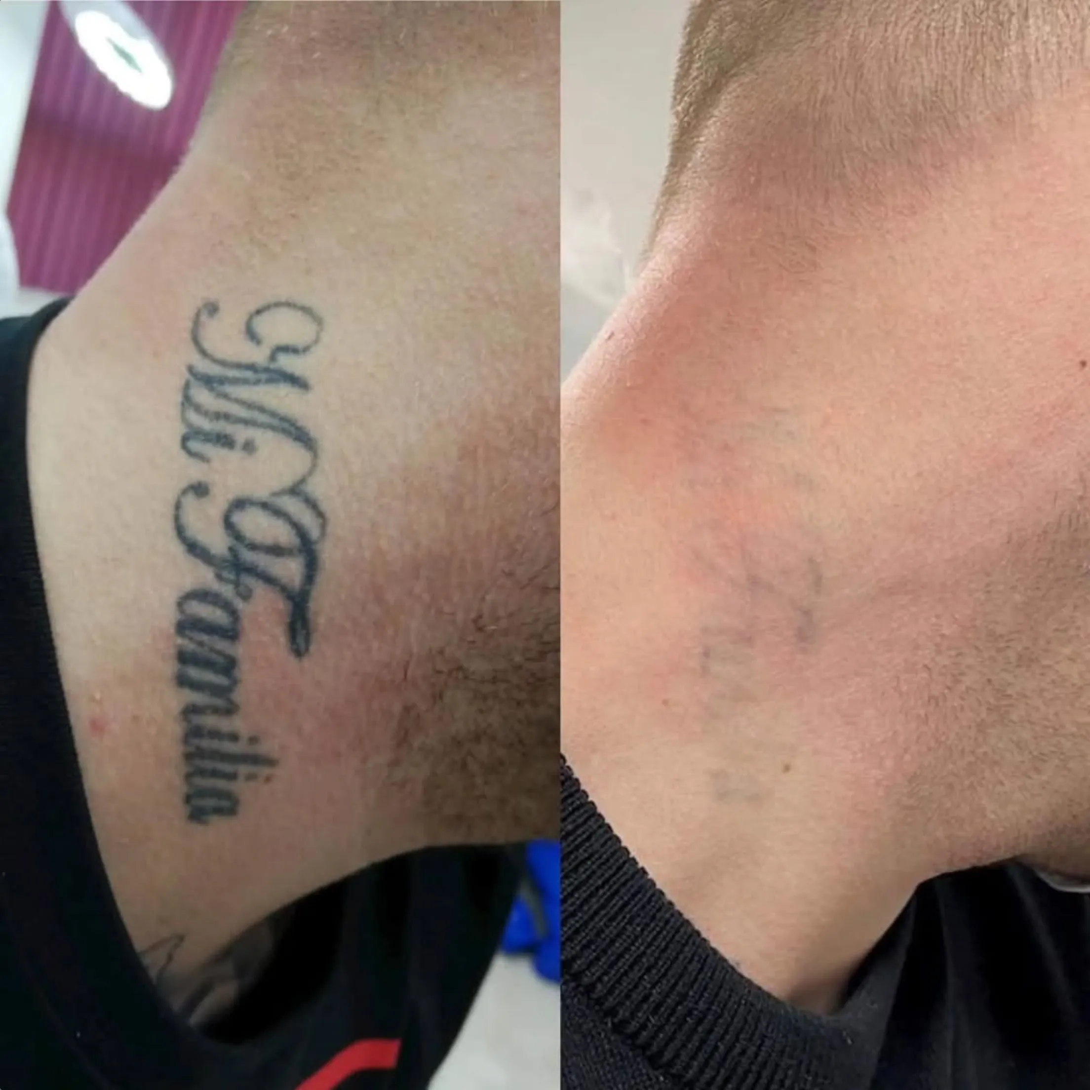 tattoo laser removal melbourne